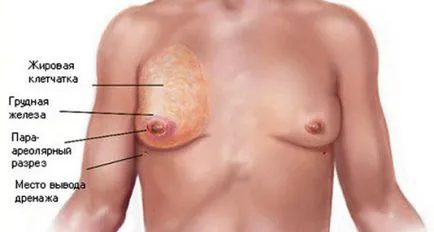 Мъж случаи на гърдата на отклонение от нормата