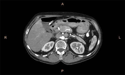 MRI ретроперитонеален