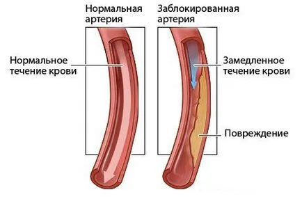 Multifokális atherosclerosis tünetek, diagnózis és kezelés