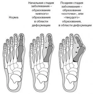 Традиционните методи за лечение на костите на краката си