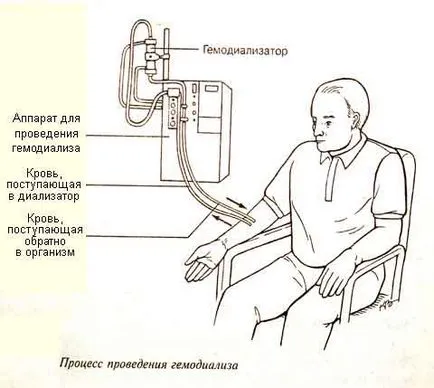 Нефрология бъбречна диализа