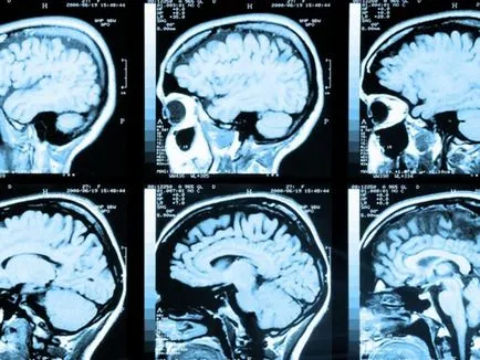 Normál nyomású hydrocephalus felnőttek okoz és kezelésére hydrocephalus