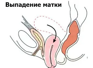 Хирургия за маточната пролапс симптоми и причини, рехабилитация след операцията