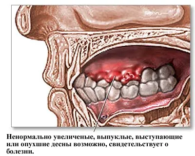 Gum подуване и отоци