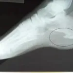 Osteofite calcaneuses simptomele și tratamentul călcâi