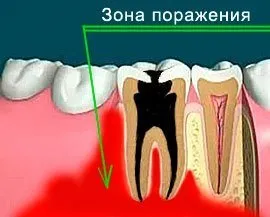 Остеомиелит симптоми и лечение при децата