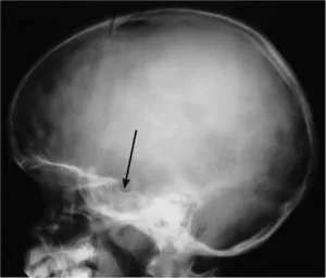 Osteoporoza Sella, tratament si cauze