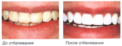 albirea dintilor, clinica dentara „Prime Stomatologie“