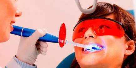 albirea dintilor, stomatologie