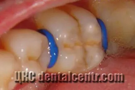 Основните етапи на ортодонтски скоби