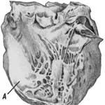 Boncolás - szívroham - és - Orvosi Encyclopedia - orvosi szerver