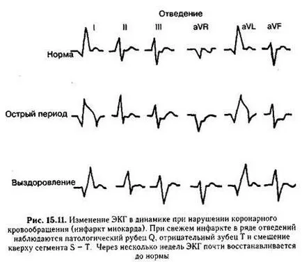 electrocardiogramă anormală