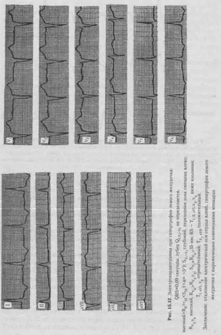 electrocardiogramă anormală