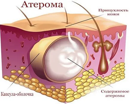 Eltávolítása atheroma sebészeti, rádióhullám, lézeres kezelés gyermekeknél és felnőtteknél