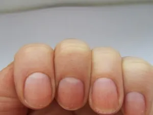 De ce unghiile devin ondulate, striate