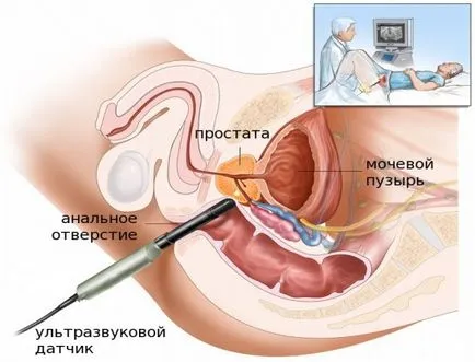 Получаване на ултразвук на простатата (простатен)