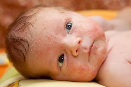 Бодлива топлина при новороденото - как да се справят с нея видео