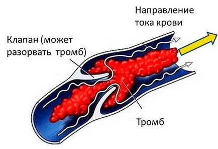 Препарати за лечение на венозна тромбоза