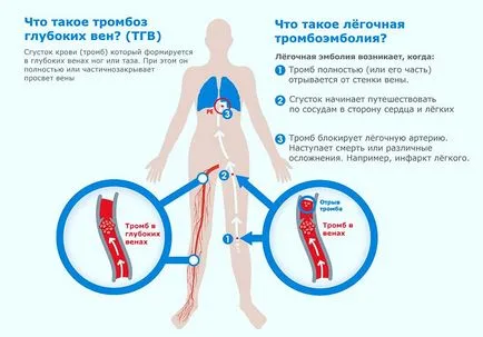 Препарати за лечение на венозна тромбоза