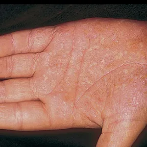 Okok és allergia kezelésére a tenyér, a kéz és az ujjak a hideg gyermek - szól allergia