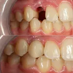 etape de implant protezare si preturi, costul coroanei pe implant, coroana sau implant,