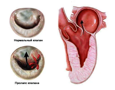 Пролапс на митралната клапа една степен предния капак