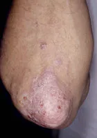 Psoriasis és elengedése