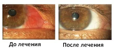 cauze oculare pterigion, tratarea și eliminarea, simptome
