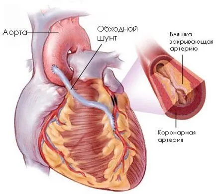 Rehabilitáció után CABG testmozgás, táplálkozás, a testmozgás