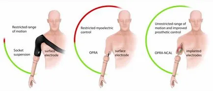 A robot protézis vált klinikai valóság