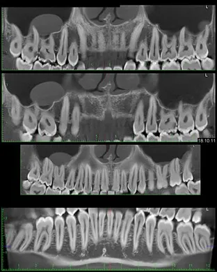 Asigurați-CBCT, con-fascicul de tomografie computerizata 3D, pret