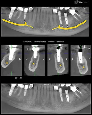 Asigurați-CBCT, con-fascicul de tomografie computerizata 3D, pret