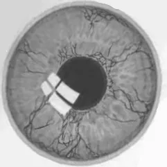 Simptome și semne de astigmatism, despre boala de ochi