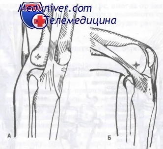 Szindrómák súrlódási Ilio-tibialis traktus és Fabella