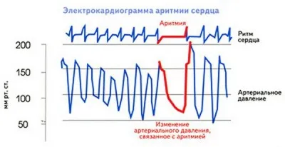 Sinus arrhythmia a szív okoz, a tünetek, a kezelés