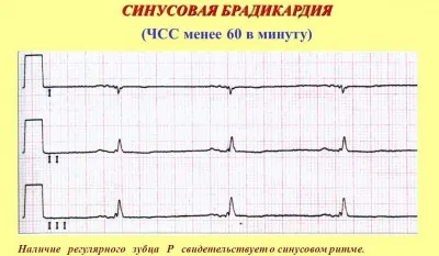 Sinus arrhythmia a szív okoz, a tünetek, a kezelés