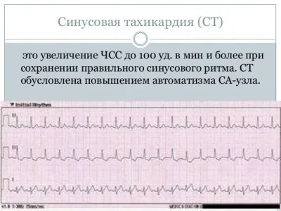 Sinus arrhythmia a szív okoz, a tünetek, a kezelés