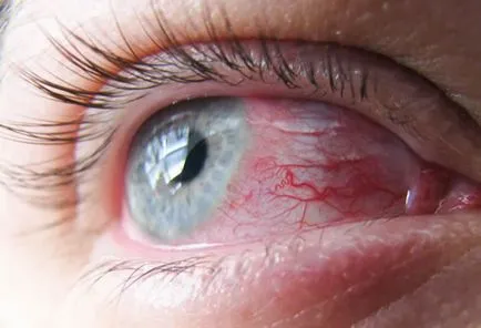 Симптоми и лечение на конюнктивит - всички форми на възпаление на лигавицата на очите