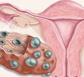 Speciális diéta kezelésére policisztás ovárium népi jogorvoslat