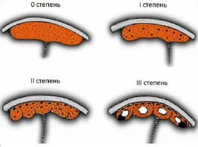 Степента на зрялост на плацентата от седмица (виж таблицата)