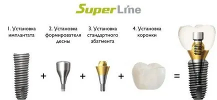 SuperLine импланти преглед директория, ползи, монтаж, експлоатационен живот