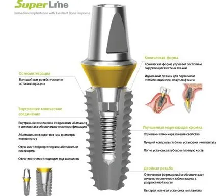 SuperLine импланти преглед директория, ползи, монтаж, експлоатационен живот