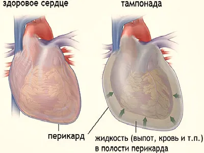 Сърдечна тампонада какво е