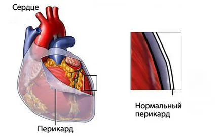 Сърдечна тампонада причини, признаци, симптоми, последствия