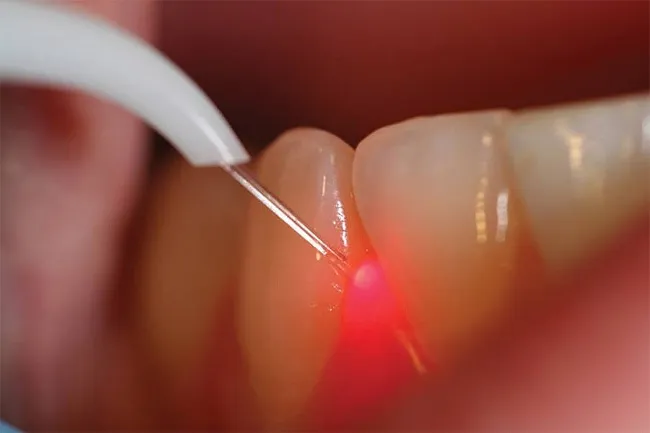 Tehnica de coagulare a gingiilor
