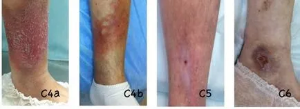 Visszértágulás dermatitis (bőrelváltozásokat) az alsó végtagok, hogy kezeljük kenőcsök és