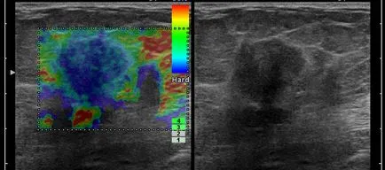 Ultrahang elastographia rák meghatározás Mmmologista, nőgyógyászat, urológia