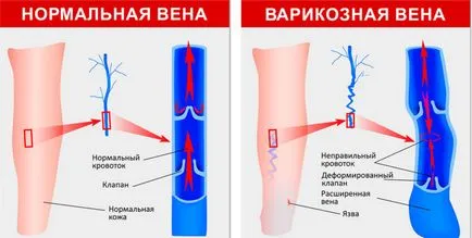 Разширени дерматит (липодерматосклероза) на долните крайници, че се третира с мехлеми и