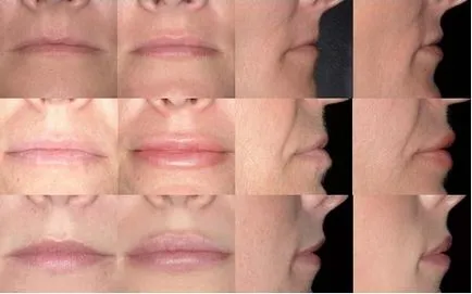Mărirea buzelor cu implanturi de silicon permalip labial, plastic 3d (nou în chirurgie frumusete)