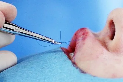 Ajakfeltöltés implantátumok (fotók)